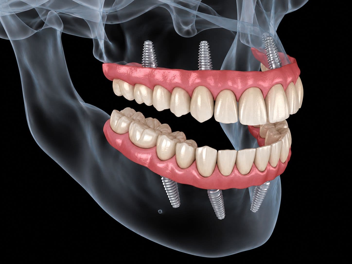 Full Mouth Rehabilitation: Complete Clinical Guide