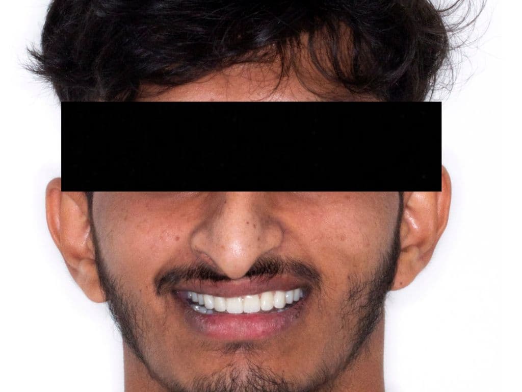 Before - Quad Zygomatic Implants
