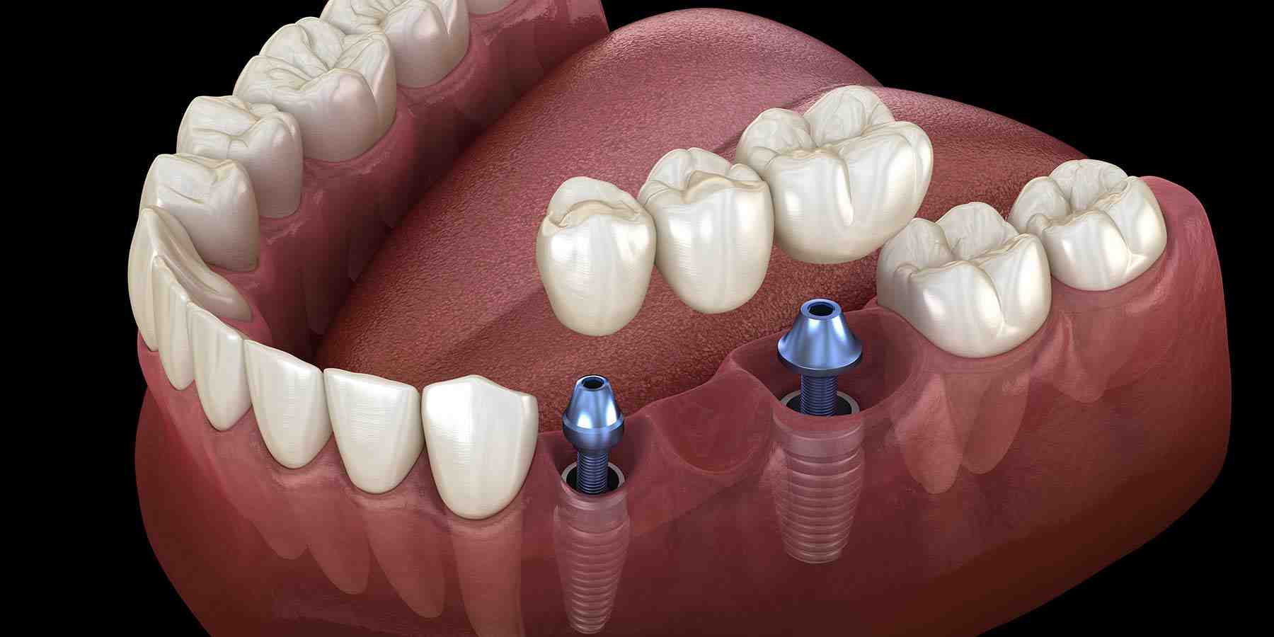 Dental Implant Surgery: Complete Patient Guide